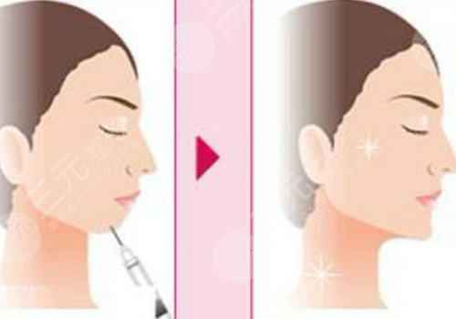 玻尿酸填充下巴有什么副作用？