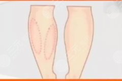 小腿脂肪太多还松垮怎么整形？2种方案分享，美腿塑形计划！