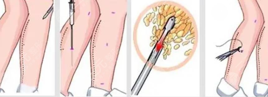 小腿脂肪太多还松垮怎么整形？2种方案分享，美腿塑形计划！