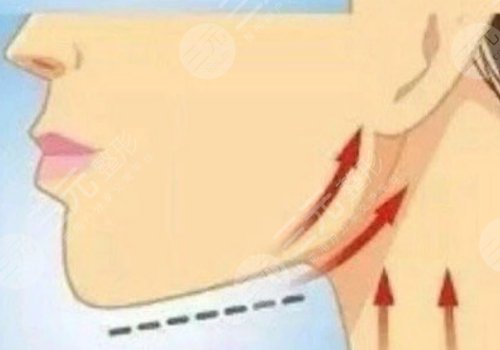 下颌线提升前后对比图