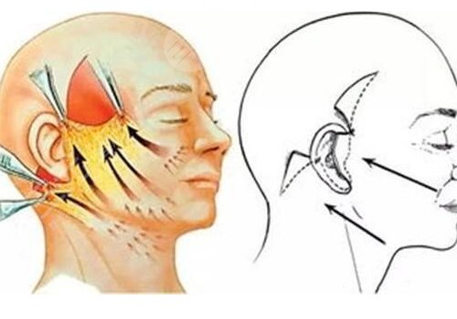 筋膜悬吊术适合多大年龄的?
