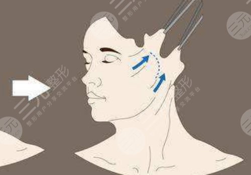 筋膜悬吊术适合多大年龄的?