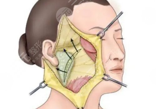 筋膜悬吊术适合多大年龄的?