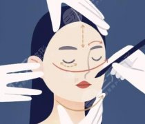 轮廓固定和筋膜提升的区别是什么？抗衰不同方案对比解说！