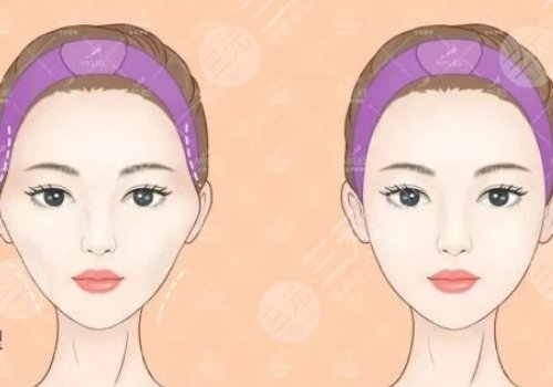 胶原蛋白填充太阳凹大概多少钱？