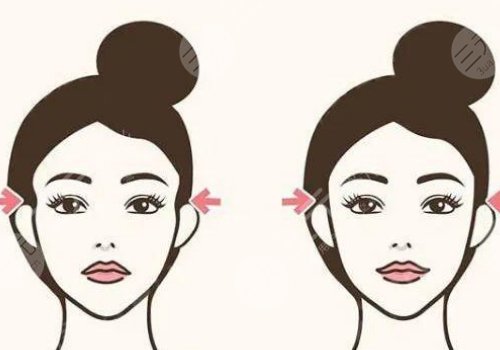 胶原蛋白填充太阳凹大概多少钱？