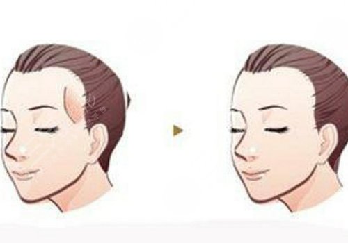 胶原蛋白填充太阳凹大概多少钱？