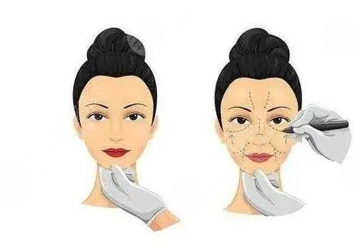 什么叫轮廓整形手术？