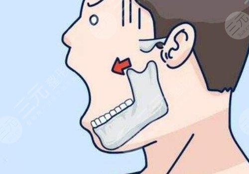 轮廓整形一般需要多少钱？贵不贵？