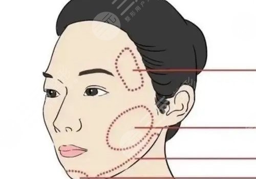 轮廓固定提升多少钱做一次好？