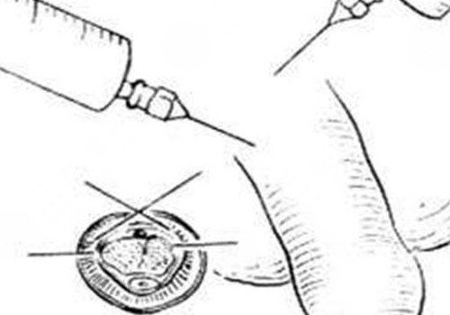 玻尿酸男性增大注射要多少钱？