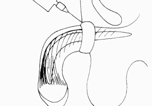 玻尿酸男性增大注射要多少钱？