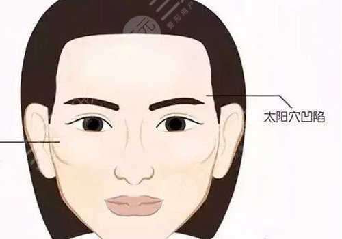 玻尿酸填充太阳凹大概多少钱？