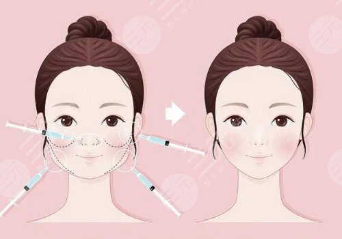 面颊凹陷用什么玻尿酸填充好?