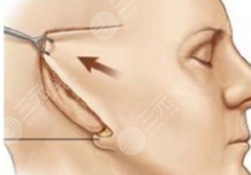 面部提升术的危害有什么？