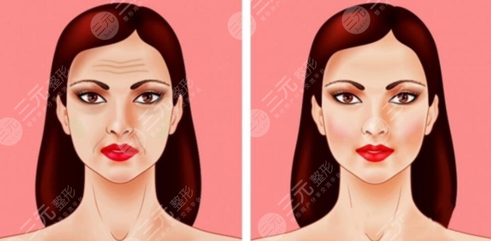 北京加减美医院面部提升术案例