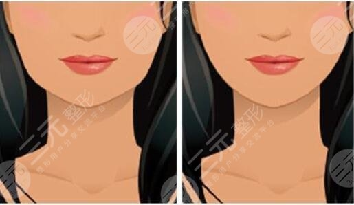 做了下颌线提升之后需要注意什么?