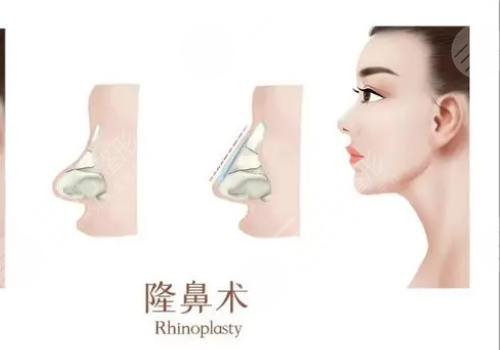 靳玉彪做的鼻子怎么样