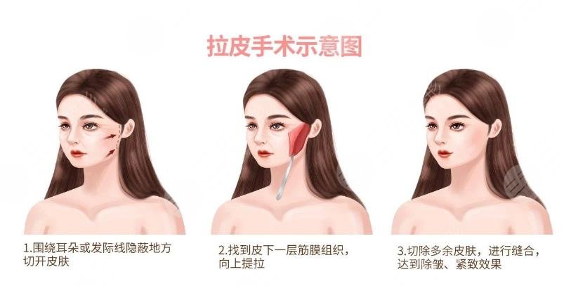 覃永喜医生拉皮案例