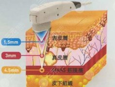35岁面部提升好的方法有哪些?4种医美项目,除皱抗衰可选! 35岁面部提升好的方法有哪些?4种医美项目,除皱抗衰可选!