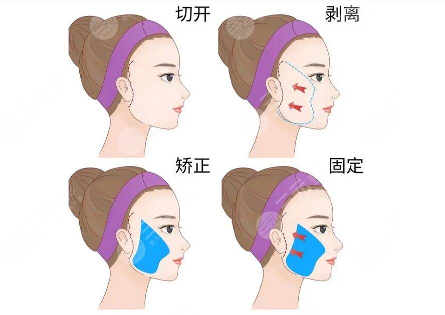 武汉美基元项利姣做的案例分享