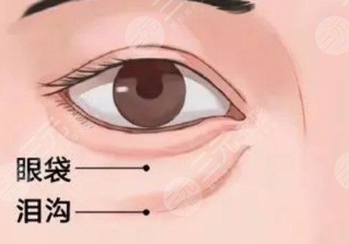 填泪沟用胶原蛋白多少钱?