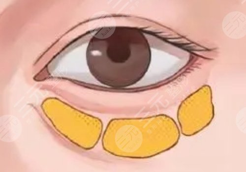 填泪沟用胶原蛋白多少钱?