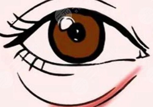 填泪沟用胶原蛋白多少钱?