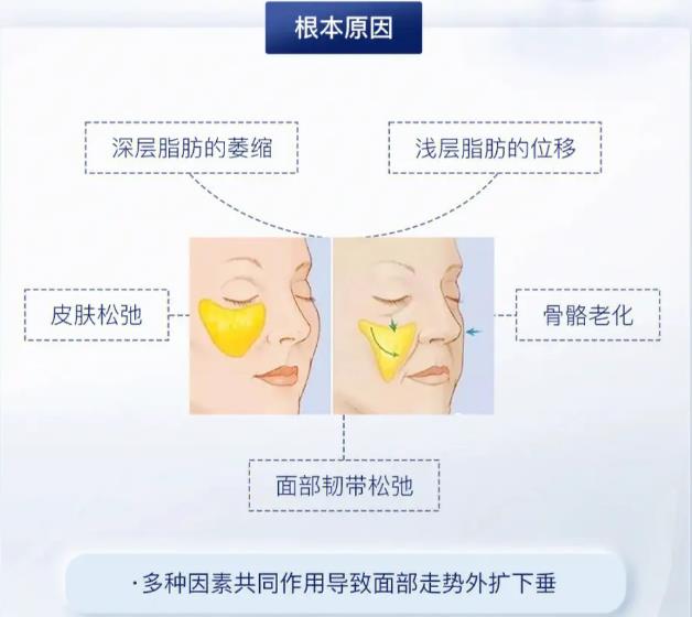 医美轮廓固定做什么项目好?科普分享,抗衰新潮流! 医美轮廓固定做什么项目好?科普分享,抗衰新潮流!
