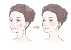 改良脸部轮廓做什么整形项目好？磨骨（削骨）、面部吸脂（填充）均可实现！