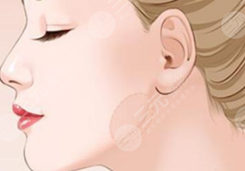 下颌提升针几天有效果