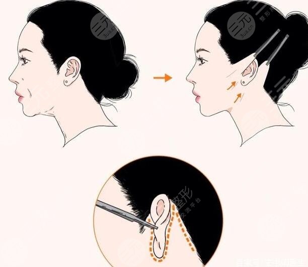 小拉皮手术全过程分享