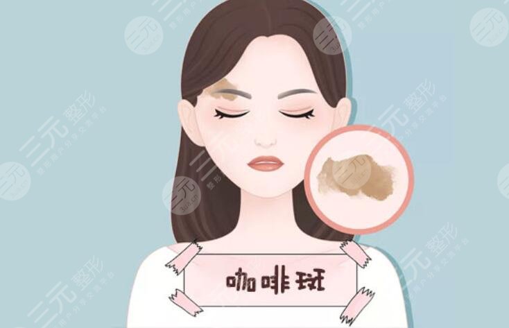 咖啡斑