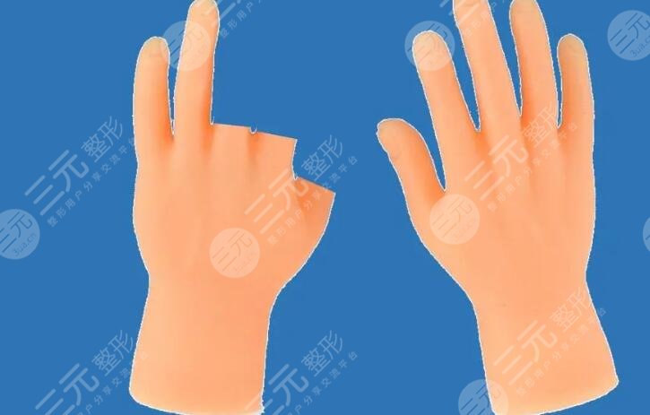 手指残缺整形