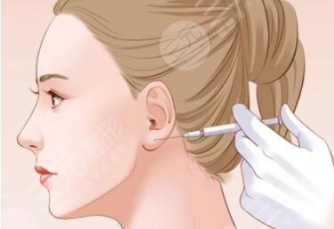 内轮廓固定外轮廓固定