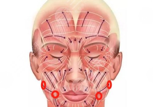 筋膜悬吊面部提升术保持多久？