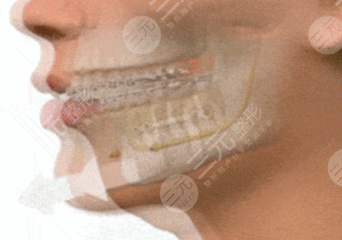 脸部骨骼变形能矫正吗?