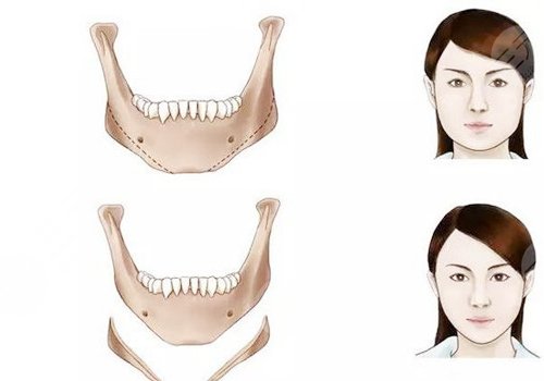 脸部骨骼变形能矫正吗?