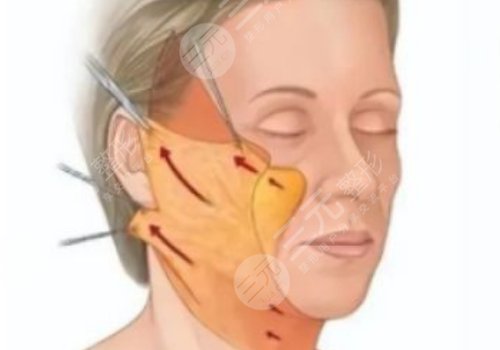 筋膜悬吊面部提升术恢复期多久？