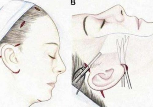 筋膜悬吊面部提升术恢复期多久？