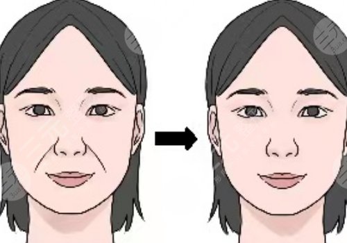 筋膜悬吊面部提升术恢复期多久？