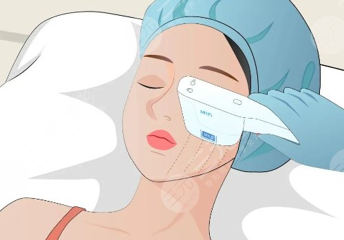 超声炮三天后脸变方