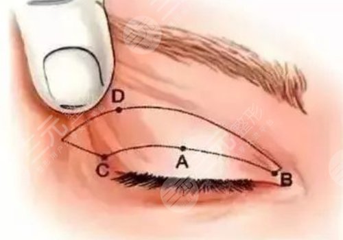 做眼部提拉手术能维持多久?