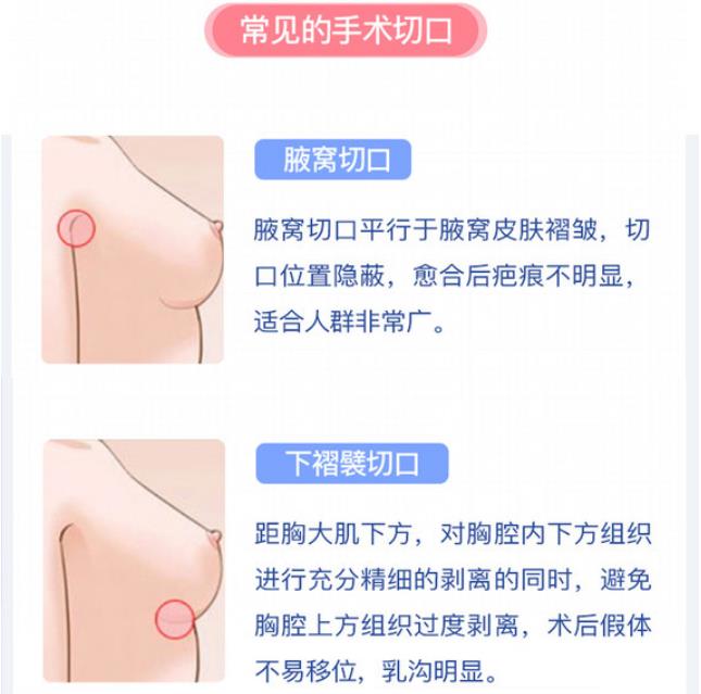 下皱襞隆胸跟腋下隆胸区别对比！手术优缺点分析，术前必看~