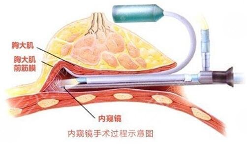 隆胸