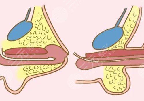 男人增长手术大概需要多少钱？