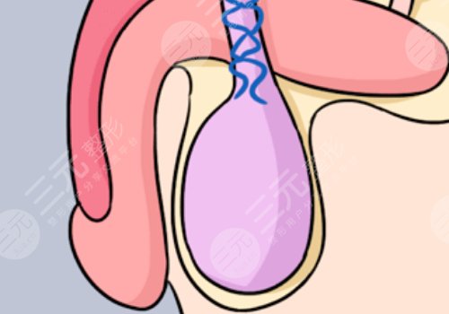 男人增长手术大概需要多少钱？