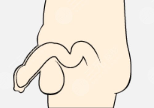 男人增长手术大概需要多少钱？