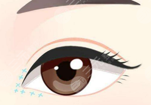 福州海峡医院双眼皮价格多少钱