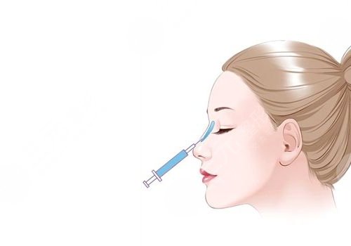 成都玉之光黄开亮做鼻子怎么样？